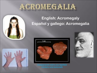 English: Acromegaly
Español y gallego: Acromegalia




  Comparación entre una hipófisis
     normal y una tumorada
 