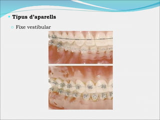Tipus d’aparells Fixe vestibular 