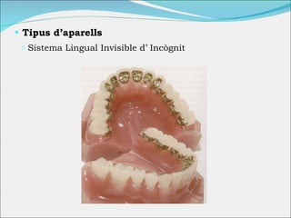Tipus d’aparells Sistema Lingual Invisible d’  Incògnit 