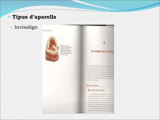 Tipus d’aparells Invisalign 