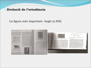 Evolució de l’ortodòncia La figura  més important: Angle (s.XIX) 