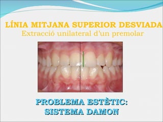 LÍNIA MITJANA SUPERIOR DESVIADA  Extracció unilateral d’un premolar  PROBLEMA ESTÈTIC: SISTEMA DAMON 