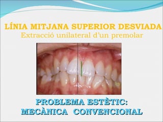LÍNIA MITJANA SUPERIOR DESVIADA  Extracció unilateral d’un premolar  PROBLEMA ESTÈTIC: MECÀNICA  CONVENCIONAL 