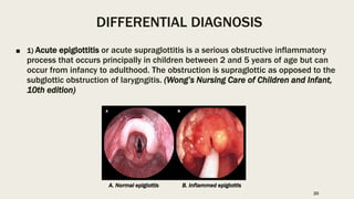 DIFFERENTIAL DIAGNOSIS
■ 1) Acute epiglottitis or acute supraglottitis is a serious obstructive inflammatory
process that occurs principally in children between 2 and 5 years of age but can
occur from infancy to adulthood. The obstruction is supraglottic as opposed to the
subglottic obstruction of larygngitis. (Wong’s Nursing Care of Children and Infant,
10th edition)
A. Normal epiglottis B. Inflammed epiglottis
20
 