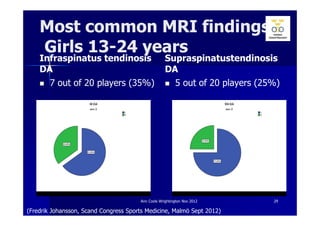Most common MRI findings
    Girls 13-24 years
    Infraspinatus tendinosis                        Supraspinatustendinosis
    DA                                              DA
      7 out of 20 players (35%)                       5 out of 20 players (25%)




                                       Ann Cools Wrightington Nov 2012       29

(Fredrik Johansson, Scand Congress Sports Medicine, Malmö Sept 2012)
 