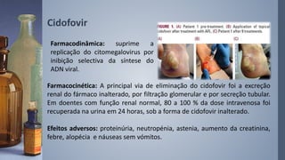 Cidofovir
Farmacodinâmica: suprime a
replicação do citomegalovirus por
inibição selectiva da síntese do
ADN viral.
Farmacocinética: A principal via de eliminação do cidofovir foi a excreção
renal do fármaco inalterado, por filtração glomerular e por secreção tubular.
Em doentes com função renal normal, 80 a 100 % da dose intravenosa foi
recuperada na urina em 24 horas, sob a forma de cidofovir inalterado.
Efeitos adversos: proteinúria, neutropénia, astenia, aumento da creatinina,
febre, alopécia e náuseas sem vómitos.
 