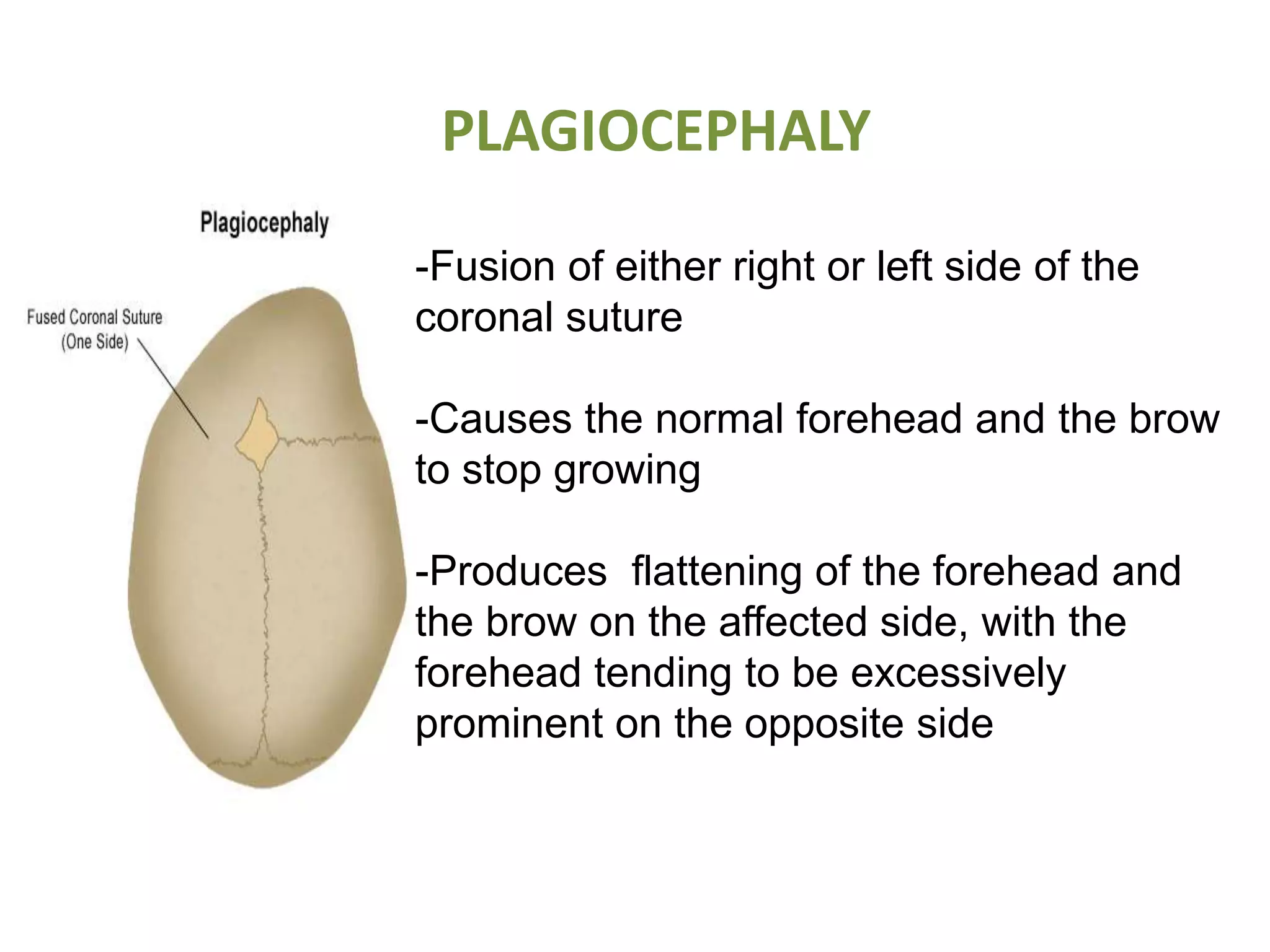-Fusion of either right or left side of the
coronal suture
-Causes the normal forehead and the brow
to stop growing
-Produces flattening of the forehead and
the brow on the affected side, with the
forehead tending to be excessively
prominent on the opposite side
PLAGIOCEPHALY
 