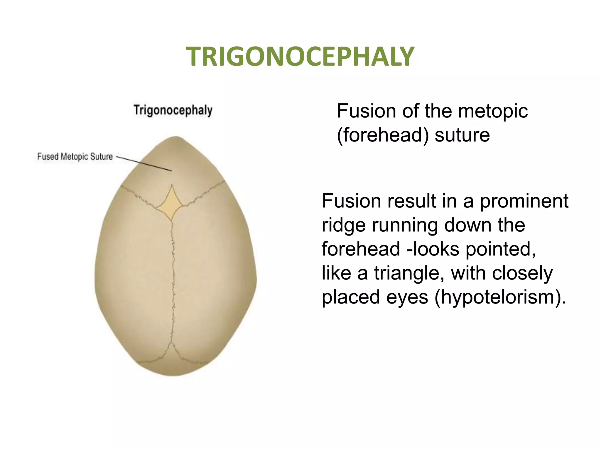 TRIGONOCEPHALY
Fusion of the metopic
(forehead) suture
Fusion result in a prominent
ridge running down the
forehead -looks pointed,
like a triangle, with closely
placed eyes (hypotelorism).
 