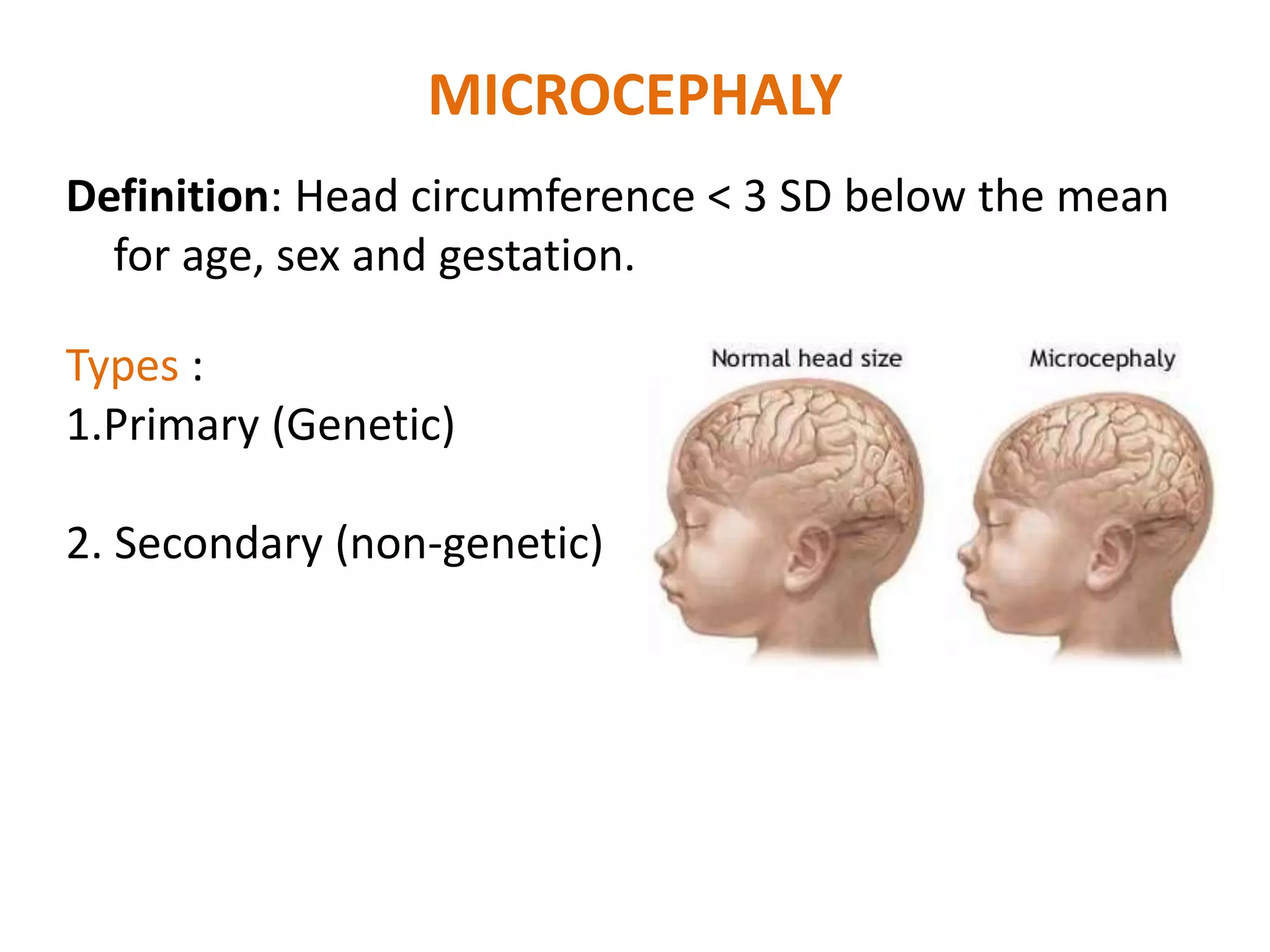 MICROCEPHALY
Definition: Head circumference < 3 SD below the mean
for age, sex and gestation.
Types :
1.Primary (Genetic)
2. Secondary (non-genetic)
 