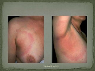 Annular erythema | PPSX