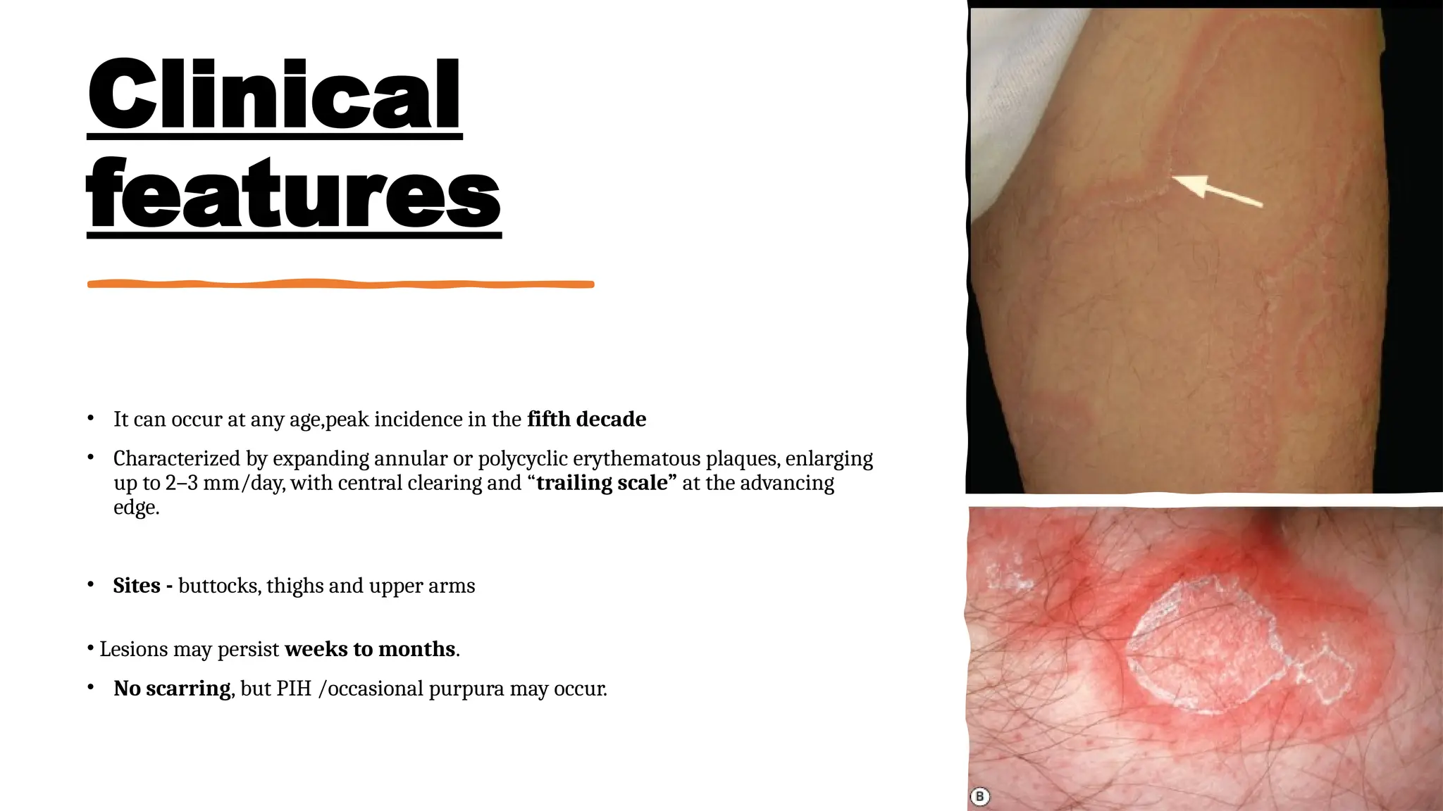 Annular erythema .Annular erythema is a descriptive term that ...