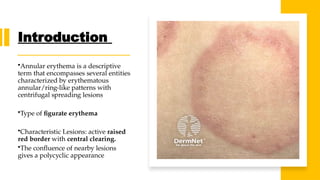 Annulaur Rash Diffuse Annular erythema .Annular erythema is a descriptive term that ...