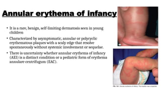 Annular erythema .Annular erythema is a descriptive term that ...