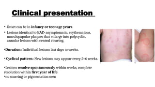 Annular erythema .Annular erythema is a descriptive term that ...