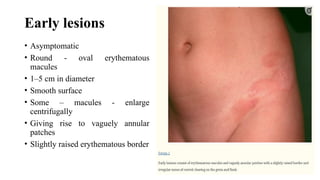 Энхцог Annular lichenoid dermatitis editedbyUB.pptx