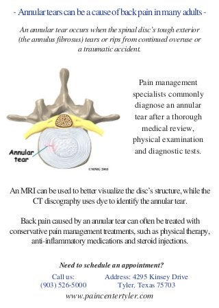 - Annular tears can be a cause of back pain in many adults -
An MRI can be used to better visualize the disc’s structure, while the
CT discography uses dye to identify the annular tear.
Back pain caused by an annular tear can often be treated with
conservative pain management treatments, such as physical therapy,
anti-inflammatory medications and steroid injections.
 
Call us:
(903) 526-5000
Address: 4295 Kinsey Drive
Tyler, Texas 75703
An annular tear occurs when the spinal disc’s tough exterior
(the annulus fibrosus) tears or rips from continued overuse or
a traumatic accident.
Need to schedule an appointment?
www.paincentertyler.com
Pain management
specialists commonly
diagnose an annular
tear after a thorough
medical review,
physical examination
and diagnostic tests.
 