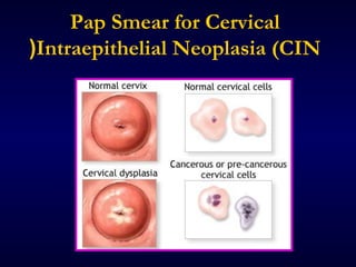 Pap Smear for Cervical
(Intraepithelial Neoplasia (CIN

 
