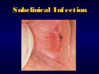 Subclinical Inf ection

 