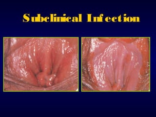Subclinical Inf ection

 