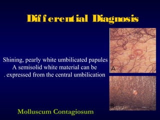 Dif f erential Diagnosis

Shining, pearly white umbilicated papules
A semisolid white material can be
. expressed from the central umbilication

Molluscum Contagiosum

 