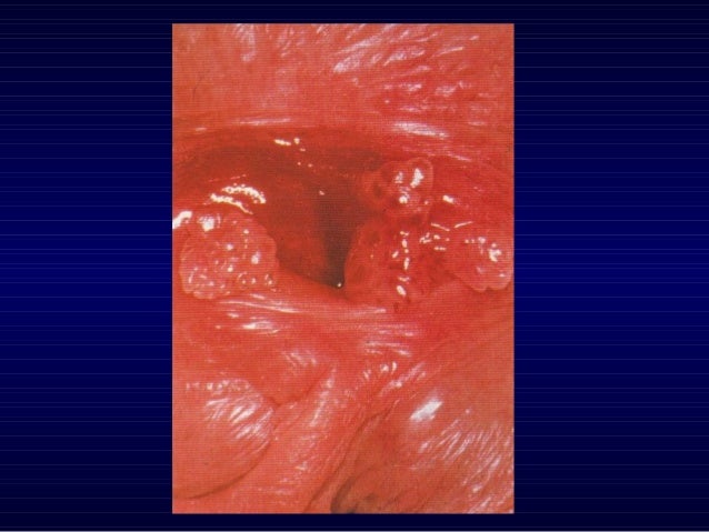 Genital Warts: Causes, Symptoms, and Treatments - Medical ...