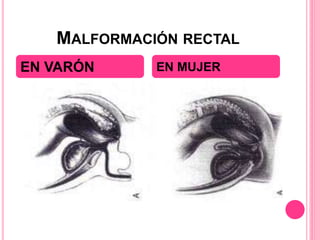 MALFORMACIÓN RECTAL
EN VARÓN EN MUJER
 