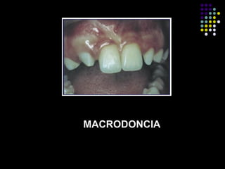 MACRODONCIA
 