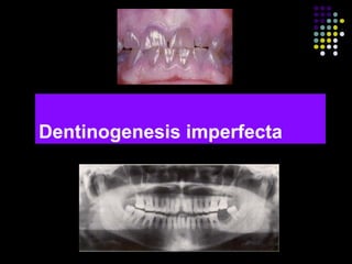 Dentinogenesis imperfecta
 