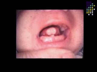 Anomalías dentales