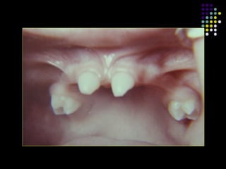 Anomalías dentales