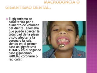  El gigantismo se
caracteriza por el
aumento de volumen
del diente, anomalía
que puede abarcar la
totalidad de la pieza
o solo afectar a la
corona o la raíz,
siendo en el primer
caso un gigantismo
TOTAL y en el segundo
caso gigantismo
PARCIAL coronario o
radicular.
 