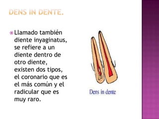  Llamado también
diente inyaginatus,
se refiere a un
diente dentro de
otro diente,
existen dos tipos,
el coronario que es
el más común y el
radicular que es
muy raro.
 