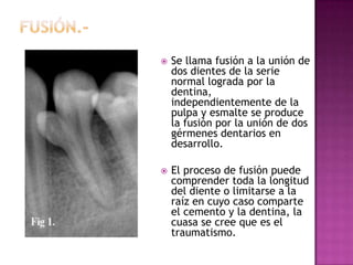  Se llama fusión a la unión de
dos dientes de la serie
normal lograda por la
dentina,
independientemente de la
pulpa y esmalte se produce
la fusión por la unión de dos
gérmenes dentarios en
desarrollo.
 El proceso de fusión puede
comprender toda la longitud
del diente o limitarse a la
raíz en cuyo caso comparte
el cemento y la dentina, la
cuasa se cree que es el
traumatismo.
 