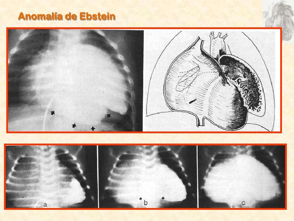 Anomalia De Ebstein Tem Cura - RETOEDU