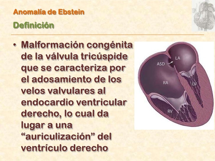 Anomalía de Ebstein