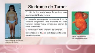 Síndrome de Turner
El 1% de los embriones femeninos con
monosomía X sobreviven.
La incidencia de 45X o síndrome de Turner en
recién nacidas es de 1 de cada 8000 nacidas vivas
aproximadamente.
La anomalía cromosómica monosomía X es la
anomalía citogenética mas frecuente en seres
humanos nacidos vivos y en fetos que abortan de
modo espontaneo.
Figura: Niña de 14 años con
síndrome de Turner.
Figura: Feto femenino
con síndrome de Turner.
 