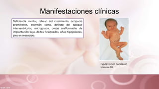 Manifestaciones clínicas
Deficiencia mental, retraso del crecimiento, occipucio
prominente, esternón corto, defecto del tabique
interventricular, micrognatia, orejas malformadas de
implantación baja, dedos flexionados, uñas hipoplásicas,
pies en mecedora.
Figura: recién nacida con
trisomía 18.
 