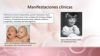 Manifestaciones clínicas
Deficiencia mental, braquicefalia, puente nasal plano, fisura
palpebral inclinada hacia arriba, prolapso de la lengua, pliegue
simiesco, clinodactilia del quinto dedo, defectos cardiacos
congénitos, anomalías del tubo digestivo.
Figura: cara de gemelos masculinos dicigoticos
discordantes para el síndrome de Down.
Figura: niña de 2 años y medio
con síndrome de Down.
 