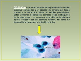 • DISPLASIA es un tipo anormal de la proliferación celular
  excesiva caracteriza por pérdida de arreglo del tejido
  normal y la estructura celular en células premalignas.
  Estos primeros neoplásicas cambios debe distinguirse
  de la hiperplasia , un aumento reversible de la división
  celular causado por un estímulo externo, tal como un
  desequilibrio hormonal o irritación crónica.
 