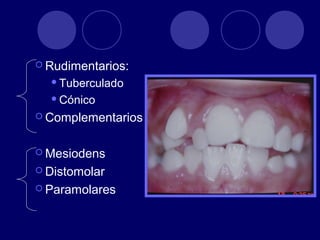  Rudimentarios:
Tuberculado
Cónico
 Complementarios
 Mesiodens
 Distomolar
 Paramolares
 