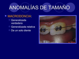 ANOMALÍAS DE TAMAÑO
 MACRODONCIA:
 Generalizada
verdadera
 Generalizada relativa
 De un solo diente
 