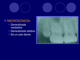  MICRODONCIA:
 Generalizada
verdadera
 Generalizada relativa
 De un solo diente
 