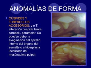 ANOMALÍAS DE FORMA
 CÚSPIDES Y
TUBERCULOS
ACCESORIOS: y o T,
alteración cúspide fisura,
carabelli, paramolar. Se
pueden deber a
evaginación del epitelio
interno del órgano del
esmalte o a hiperplasia
localizada del
mesénquima pulpar.
 