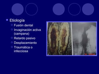  Etiología
 Fusión dental
 Invaginación activa
(campana)
 Retardo pasivo
 Desplazamiento
 Traumática o
infecciosa
 