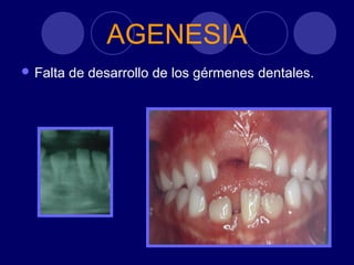 AGENESIA
 Falta de desarrollo de los gérmenes dentales.
 