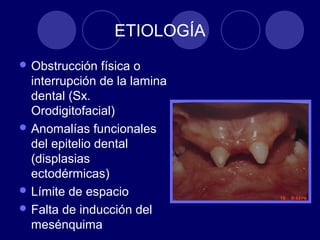 ETIOLOGÍA
 Obstrucción física o
interrupción de la lamina
dental (Sx.
Orodigitofacial)
 Anomalías funcionales
del epitelio dental
(displasias
ectodérmicas)
 Límite de espacio
 Falta de inducción del
mesénquima
 