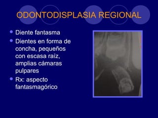 ODONTODISPLASIA REGIONAL
 Diente fantasma
 Dientes en forma de
concha, pequeños
con escasa raíz,
amplias cámaras
pulpares
 Rx: aspecto
fantasmagórico
 