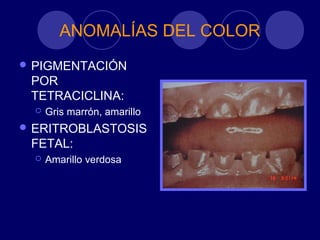 ANOMALÍAS DEL COLOR
 PIGMENTACIÓN
POR
TETRACICLINA:
 Gris marrón, amarillo
 ERITROBLASTOSIS
FETAL:
 Amarillo verdosa
 