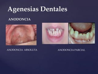 Agenesias Dentales
ANODONCIA




ANODONCIA ABSOLUTA   ANODONCIA PARCIAL
 