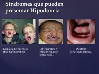 Síndromes que pueden
 presentar Hipodoncia




Displasia Ectodérmica   Labio leporino y       Displasia
(tipo hipohidrótico)    paladar hendido    condroectodérmica.
                        (hereditario).
 